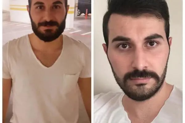 Gaziantep Saç Ekim - Fue Saç Ekim Merkezi fueestetik - Resim 13