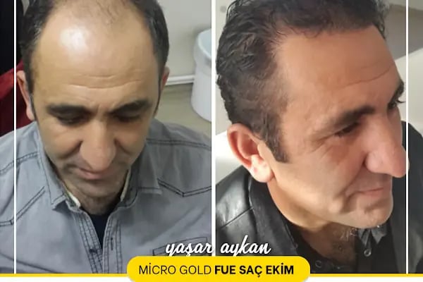 Gaziantep Saç Ekim - Fue Saç Ekim Merkezi fueestetik - Resim 17