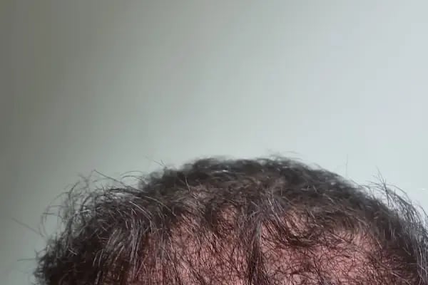 MC Hair Center Saç Ekim &amp; Estetik Merkezi - Resim 12