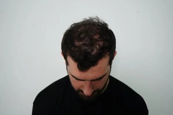 MC Hair Center Saç Ekim &amp; Estetik Merkezi - Resim 20