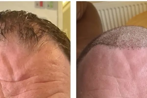 Esthetic Hair Turkey - Resim 10