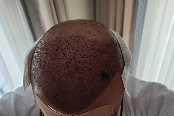 Esthetic Hair Turkey - Resim 13