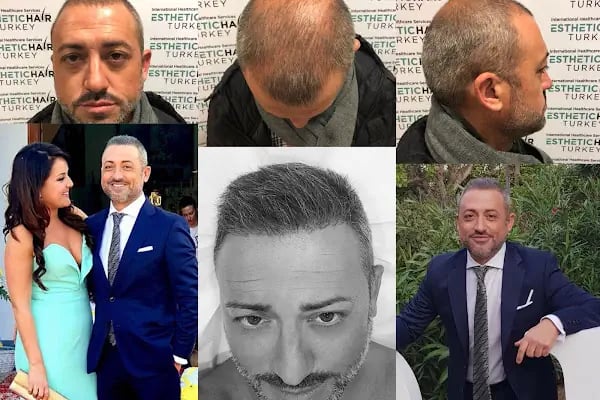 Esthetic Hair Turkey - Resim 1