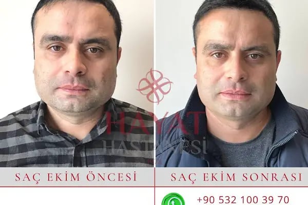 Hayat Hastanesi Saç Ekim Merkezi - Resim 18