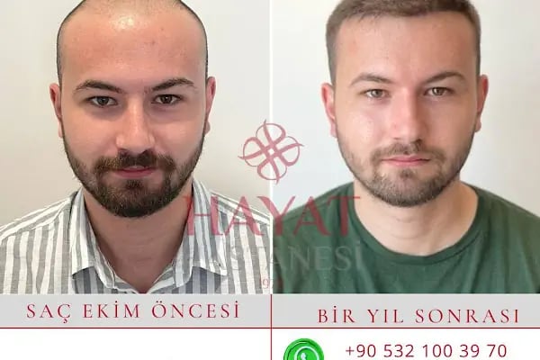 Hayat Hastanesi Saç Ekim Merkezi - Resim 7