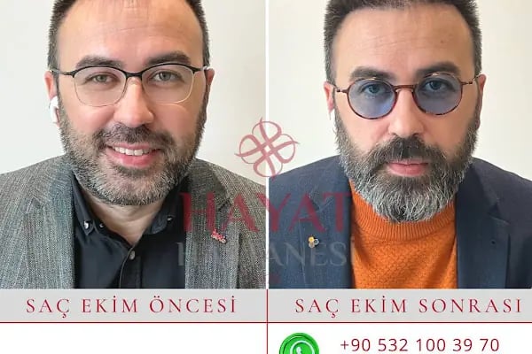 Hayat Hastanesi Saç Ekim Merkezi - Resim 13