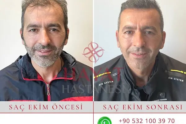 Hayat Hastanesi Saç Ekim Merkezi - Resim 8