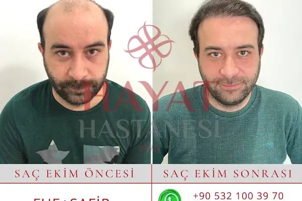 Hayat Hastanesi Saç Ekim Merkezi - Resim 19