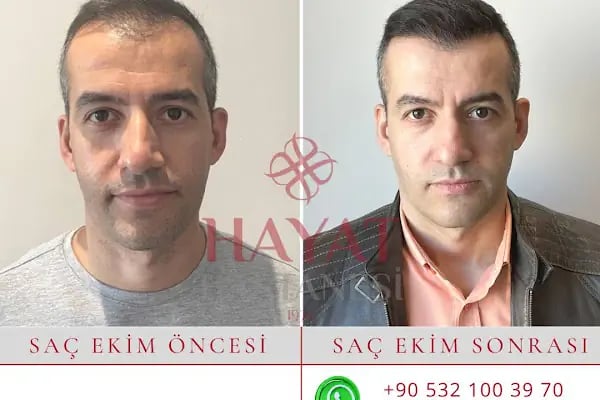 Hayat Hastanesi Saç Ekim Merkezi - Resim 4