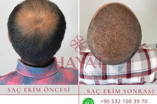 Hayat Hastanesi Saç Ekim Merkezi - Resim 16