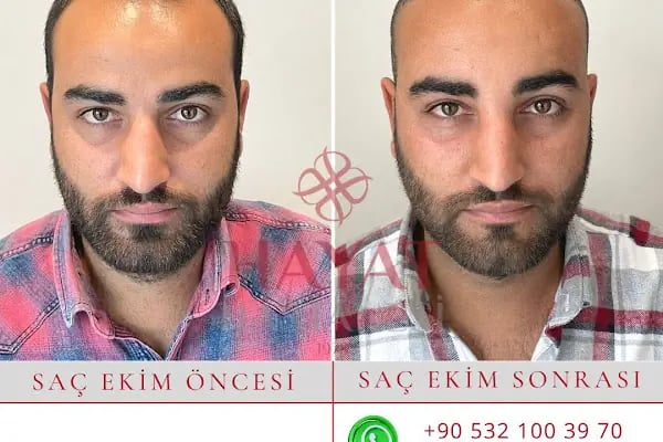 Hayat Hastanesi Saç Ekim Merkezi - Resim 9