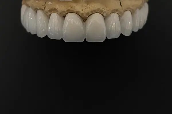 Alihan Akçam Ağız ve Diş Sağlığı Kliniği | Zirkonyum Kaplama, İmplant, Gülüş Tasarımı | Narlıdere Diş Hekimi - Resim 10