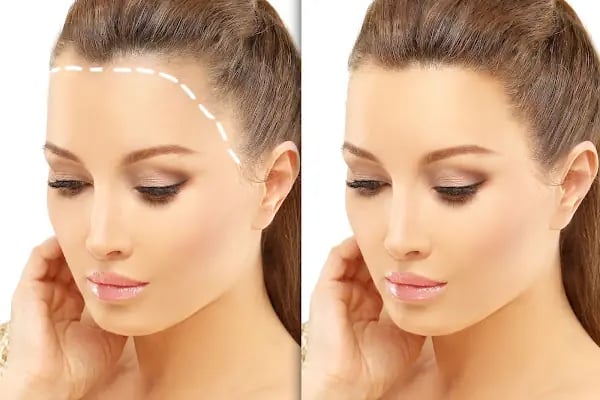 Hair Trans - Samsun Saç Ekimi - Resim 17