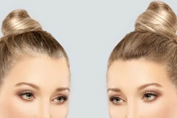Hair Trans - Samsun Saç Ekimi - Resim 11