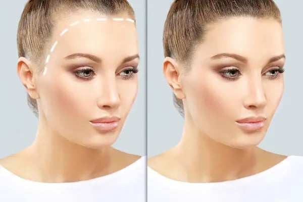 Hair Trans - Samsun Saç Ekimi - Resim 16