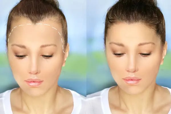 Hair Trans - Samsun Saç Ekimi - Resim 20