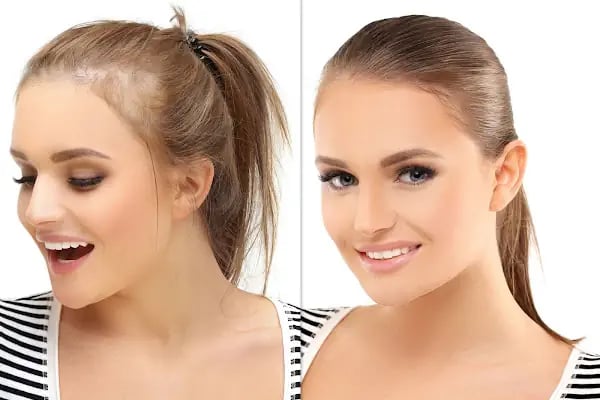 Hair Trans - Samsun Saç Ekimi - Resim 18