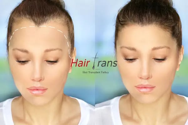 Hair Trans - Samsun Saç Ekimi - Resim 15