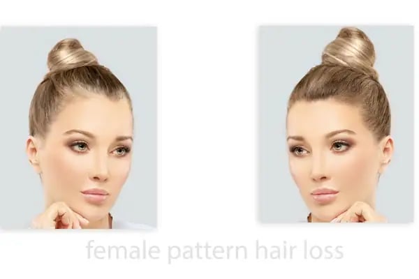 Hair Trans - Samsun Saç Ekimi - Resim 14