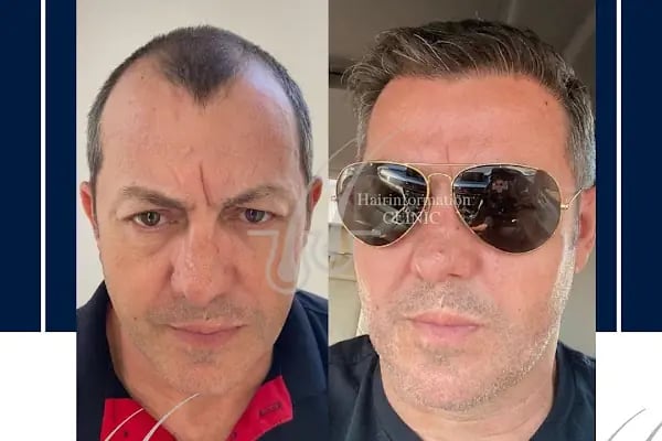 Hair Information Clinic - Saç Ekimi - Resim 11