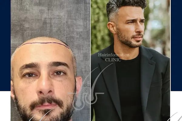 Hair Information Clinic - Saç Ekimi - Resim 4