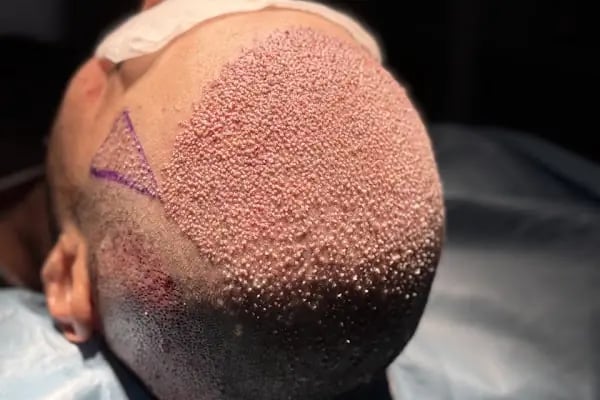 Hair Information Clinic - Saç Ekimi - Resim 14