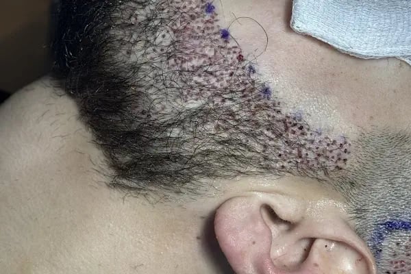 Hair Information Clinic - Saç Ekimi - Resim 19