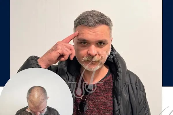 Hair Information Clinic - Saç Ekimi - Resim 6