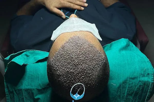 MELTEM ARGUNŞAH SAÇ EKİMİ - DHI, Sapphire &amp; Fue Hair Transplant - Resim 12