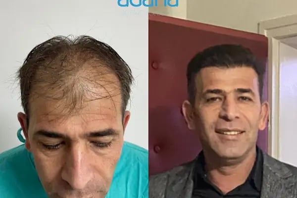 MELTEM ARGUNŞAH SAÇ EKİMİ - DHI, Sapphire &amp; Fue Hair Transplant - Resim 19