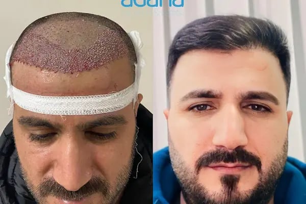 MELTEM ARGUNŞAH SAÇ EKİMİ - DHI, Sapphire &amp; Fue Hair Transplant - Resim 1
