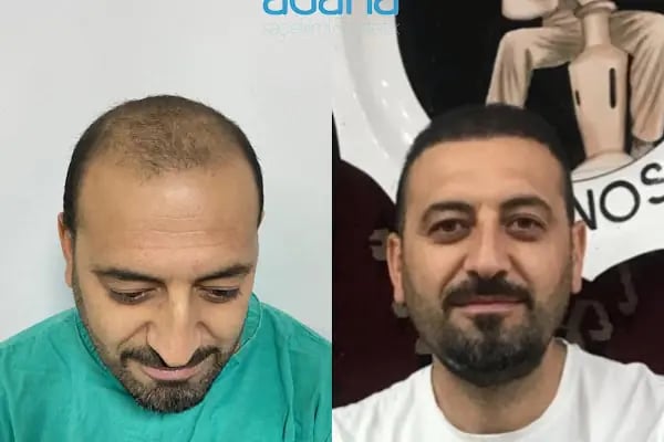 MELTEM ARGUNŞAH SAÇ EKİMİ - DHI, Sapphire &amp; Fue Hair Transplant - Resim 14