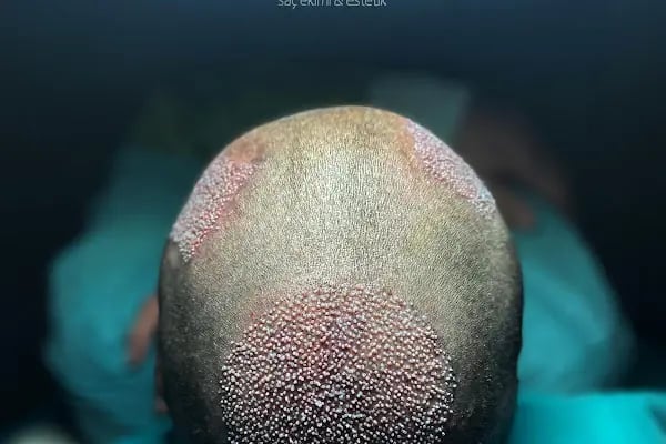 MELTEM ARGUNŞAH SAÇ EKİMİ - DHI, Sapphire &amp; Fue Hair Transplant - Resim 8