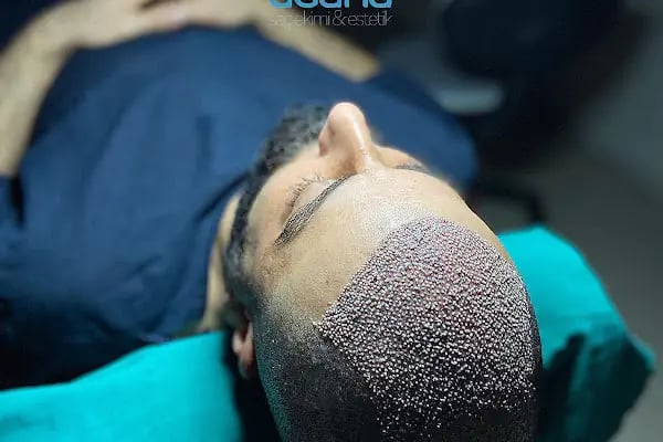 MELTEM ARGUNŞAH SAÇ EKİMİ - DHI, Sapphire &amp; Fue Hair Transplant - Resim 7
