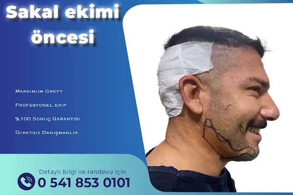 MELTEM ARGUNŞAH SAÇ EKİMİ - DHI, Sapphire &amp; Fue Hair Transplant - Resim 20