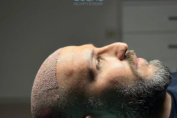 MELTEM ARGUNŞAH SAÇ EKİMİ - DHI, Sapphire &amp; Fue Hair Transplant - Resim 6