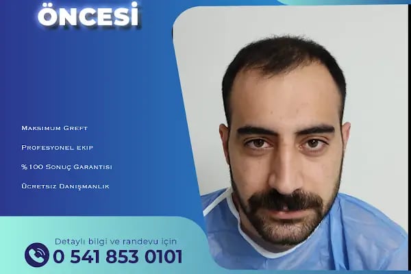 MELTEM ARGUNŞAH SAÇ EKİMİ - DHI, Sapphire &amp; Fue Hair Transplant - Resim 17