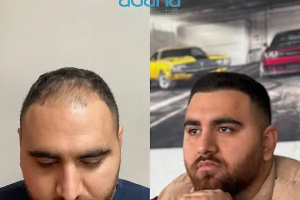 MELTEM ARGUNŞAH SAÇ EKİMİ - DHI, Sapphire &amp; Fue Hair Transplant - Resim 15