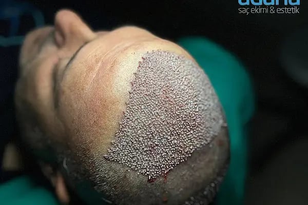 MELTEM ARGUNŞAH SAÇ EKİMİ - DHI, Sapphire &amp; Fue Hair Transplant - Resim 13