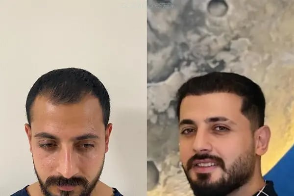 MELTEM ARGUNŞAH SAÇ EKİMİ - DHI, Sapphire &amp; Fue Hair Transplant - Resim 11