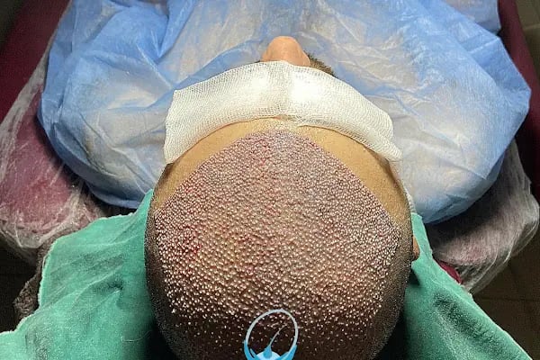 MELTEM ARGUNŞAH SAÇ EKİMİ - DHI, Sapphire &amp; Fue Hair Transplant - Resim 10