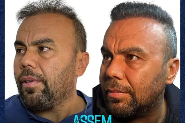 GAZİANTEP Assem Saç Ekim Merkezi - Resim 14