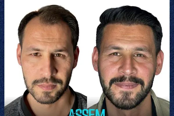 GAZİANTEP Assem Saç Ekim Merkezi - Resim 20
