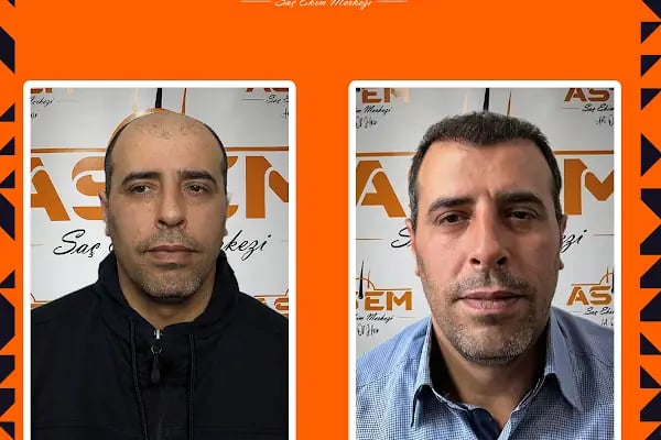 GAZİANTEP Assem Saç Ekim Merkezi - Resim 18