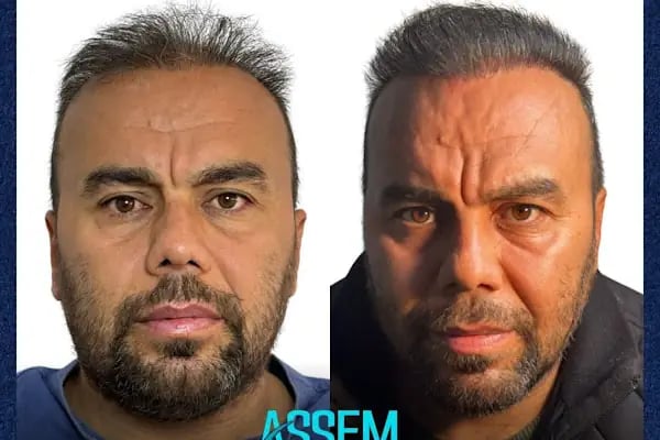 GAZİANTEP Assem Saç Ekim Merkezi - Resim 15