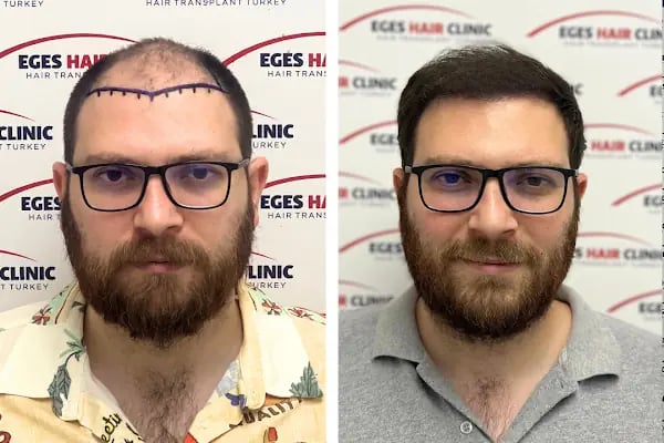 İzmir Saç Ekim Merkezi | Eges Hair Clinic - Resim 7