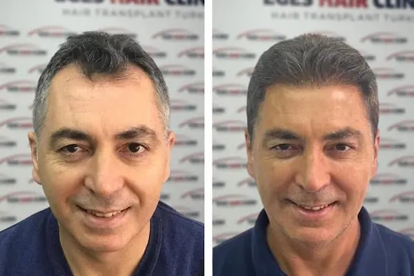 İzmir Saç Ekim Merkezi | Eges Hair Clinic - Resim 9