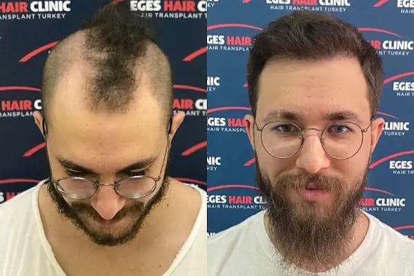 İzmir Saç Ekim Merkezi | Eges Hair Clinic - Resim 17