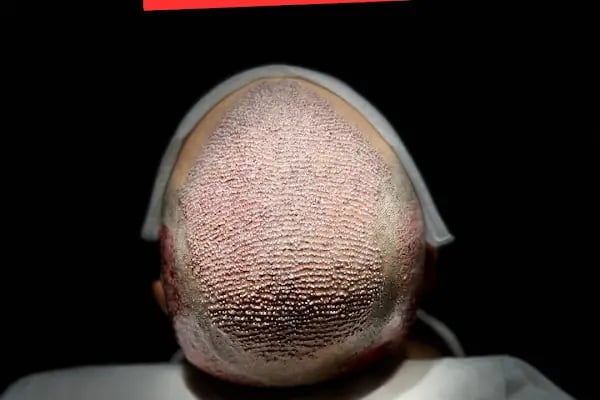 İzmir Saç Ekim Merkezi | Eges Hair Clinic - Resim 10