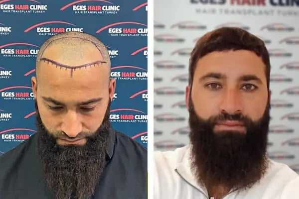 İzmir Saç Ekim Merkezi | Eges Hair Clinic - Resim 13